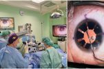 Hospital in Split implants an artificial iris for first time